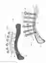 Fig. 02 - Method and system for the intramedullary fixation of a fractured bone