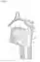 Fig. 02 - Implant systems and methods for treating obstructive sleep apnea