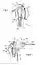 Fig. 02 - Method and instruments for positioning humeral component during shoulder arthroplasty