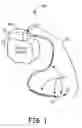 Fig. 02 - Medical electrical lead with backfilled electrode sub-assembly