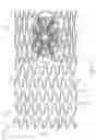Fig. 09 - Stent with Graduated Stiffness