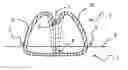 Fig. 01 - Annular Prosthesis for a Mitral Valve