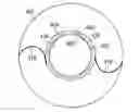 Fig. 01 - Method for creating incisions to improve intraocular lens placement