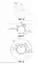 Fig. 07 - Method for creating incisions to improve intraocular lens placement