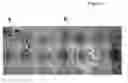 Fig. 02 - Expression of FoxP3 by cancer cells