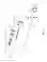 Fig. 03 - Minimal invasive neurosurgery assembly as well as a method for neurosurgery using such a neurosurgery assembly