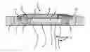 Fig. 01 - Surgical method for implanting a housing-interface assembly in a bone wall