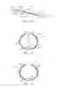 Fig. 02 - Dual modulus balloon for interventional procedures