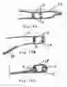 Fig. 11 - Loop Ablation Apparatus and Method