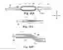 Fig. 35 - Loop Ablation Apparatus and Method