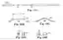 Fig. 42 - Loop Ablation Apparatus and Method