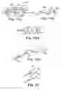 Fig. 55 - Loop Ablation Apparatus and Method