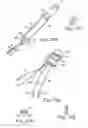 Fig. 57 - Loop Ablation Apparatus and Method