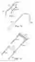 Fig. 58 - Loop Ablation Apparatus and Method