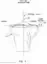 Fig. 06 - Method and apparatus for performing an open wedge, high tibial osteotomy