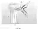Fig. 46 - Method and apparatus for performing an open wedge, high tibial osteotomy
