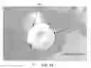 Fig. 49 - Method and apparatus for performing an open wedge, high tibial osteotomy