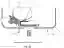 Fig. 53 - Method and apparatus for performing an open wedge, high tibial osteotomy