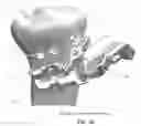 Fig. 64 - Method and apparatus for performing an open wedge, high tibial osteotomy