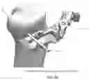Fig. 65 - Method and apparatus for performing an open wedge, high tibial osteotomy