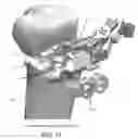 Fig. 72 - Method and apparatus for performing an open wedge, high tibial osteotomy
