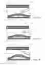 Fig. 04 - HOOD METHOD AND DEVICE FOR ENDOSCOPIC SUBMUCOSAL DISSECTION
