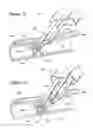 Fig. 09 - THREE-NEEDLE CLOSURE DEVICE