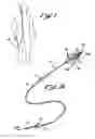 Fig. 02 - Embolectomy Catheters And Methods For Treating Stroke And Other Small Vessel Thromboembolic Disorders