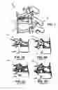 Fig. 02 - Apparatus and methods for vertebral augmentation using linked expandable bodies