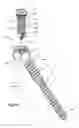 Fig. 05 - Anchor-in-anchor system for use in bone fixation