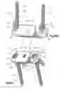 Fig. 34 - Anchor-in-anchor system for use in bone fixation