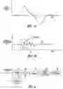 Fig. 04 - Sensing rate of change of pressure in the left ventricle with an implanted device
