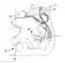 Fig. 01 - Laparoscopic implantation of neurostimulators