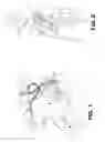 Fig. 02 - Laparoscopic implantation of neurostimulators
