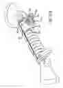 Fig. 32 - Adjustable absorber designs for implantable device