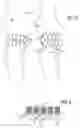 Fig. 09 - JOINT SUPPORT AND SUBCHONDRAL SUPPORT SYSTEM