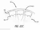 Fig. 20 - JOINT SUPPORT AND SUBCHONDRAL SUPPORT SYSTEM