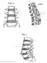 Fig. 02 - Apparatus and method for anterior intervertebral spinal fixation and fusion