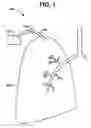 Fig. 02 - DEVICES AND METHODS TO MAINTAIN THE PATENCY OF AN OPENING RELATIVE TO PARENCHYMAL TISSUE OF THE LUNG