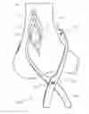 Fig. 01 - Skin-Bone Clamp