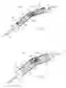 Fig. 02 - Single Wire Stent Delivery System