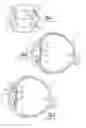 Fig. 02 - Intraocular lens and method of making an intraocular lens
