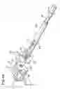Fig. 08 - Prosthetic implant with biplanar angulation and compound angles