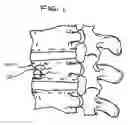 Fig. 02 - EXPANDABLE POROUS MESH BAG DEVICE AND METHODS OF USE FOR REDUCTION, FILLING, FIXATION AND SUPPORTING OF BONE