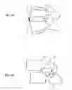 Fig. 07 - Asymmetric disc distracting cage