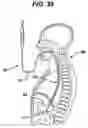 Fig. 22 - Steerable surgical access devices and methods