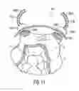 Fig. 07 - Magnetic surgical retractor