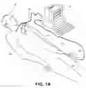 Fig. 02 - Electrode data analysis to indicate catheter stability and/or needle penetration success