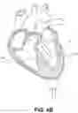 Fig. 07 - Electrode data analysis to indicate catheter stability and/or needle penetration success