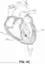Fig. 08 - Electrode data analysis to indicate catheter stability and/or needle penetration success